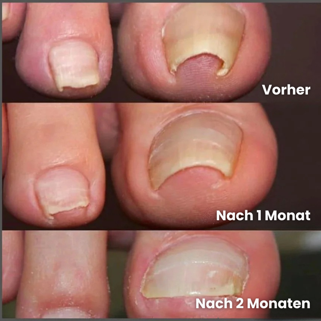 Letzter Tag -50% | PediPatch™ Nagelkorrigierende Pflaster (100 Stück)