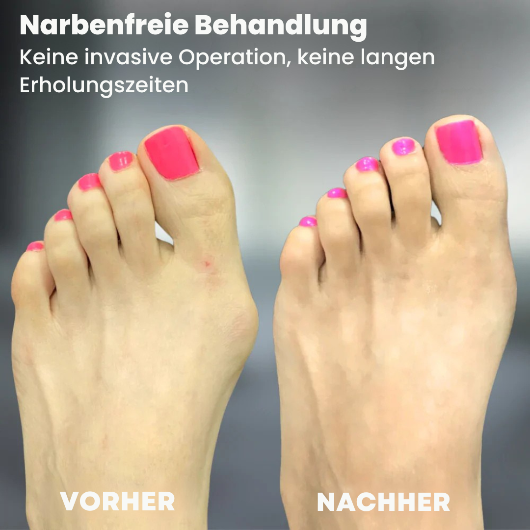 Letzter Tag -50% | ToeAlign™ Korrekturschiene bei Hallux Valgus